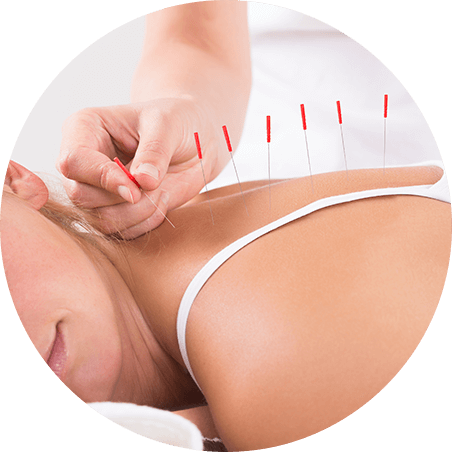 Dry Needling