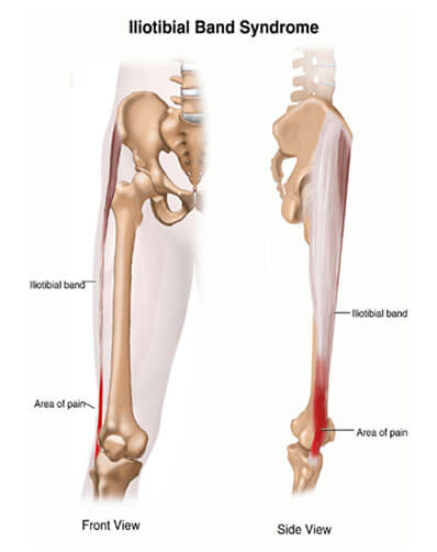 Physiotherapy and iliotibial band syndrome