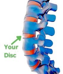 Bulging and Herniated Discs – Explained