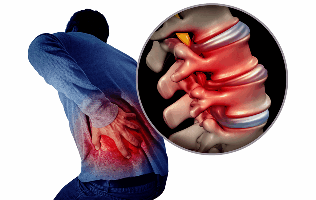 Bulging and Herniated Discs - Explained
