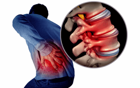Bulging and Herniated Discs - Explained